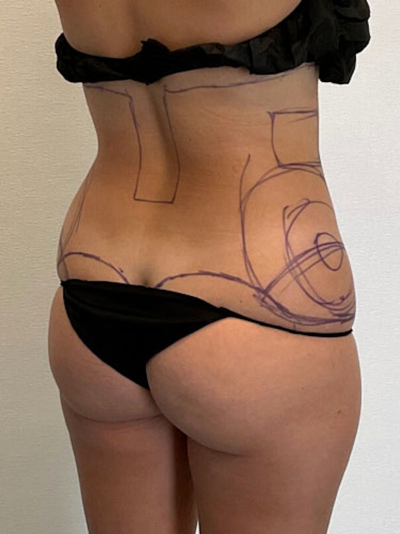 Liposuction Before & After Gallery - Patient 315029 - Image 3