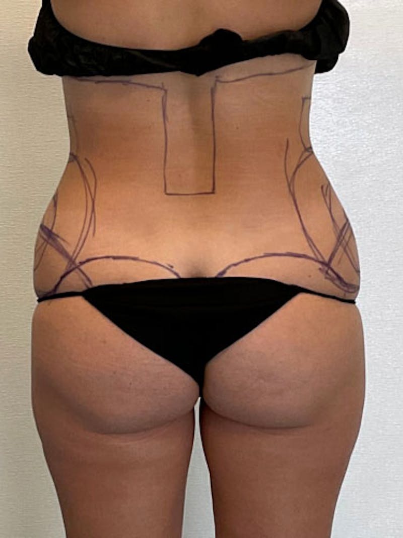 Liposuction Before & After Gallery - Patient 315029 - Image 5