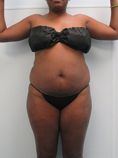 Liposuction Before & After Gallery - Patient 140815 - Image 1