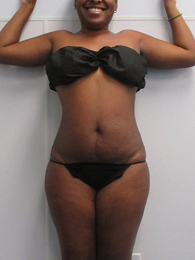 Liposuction Before & After Gallery - Patient 140815 - Image 2