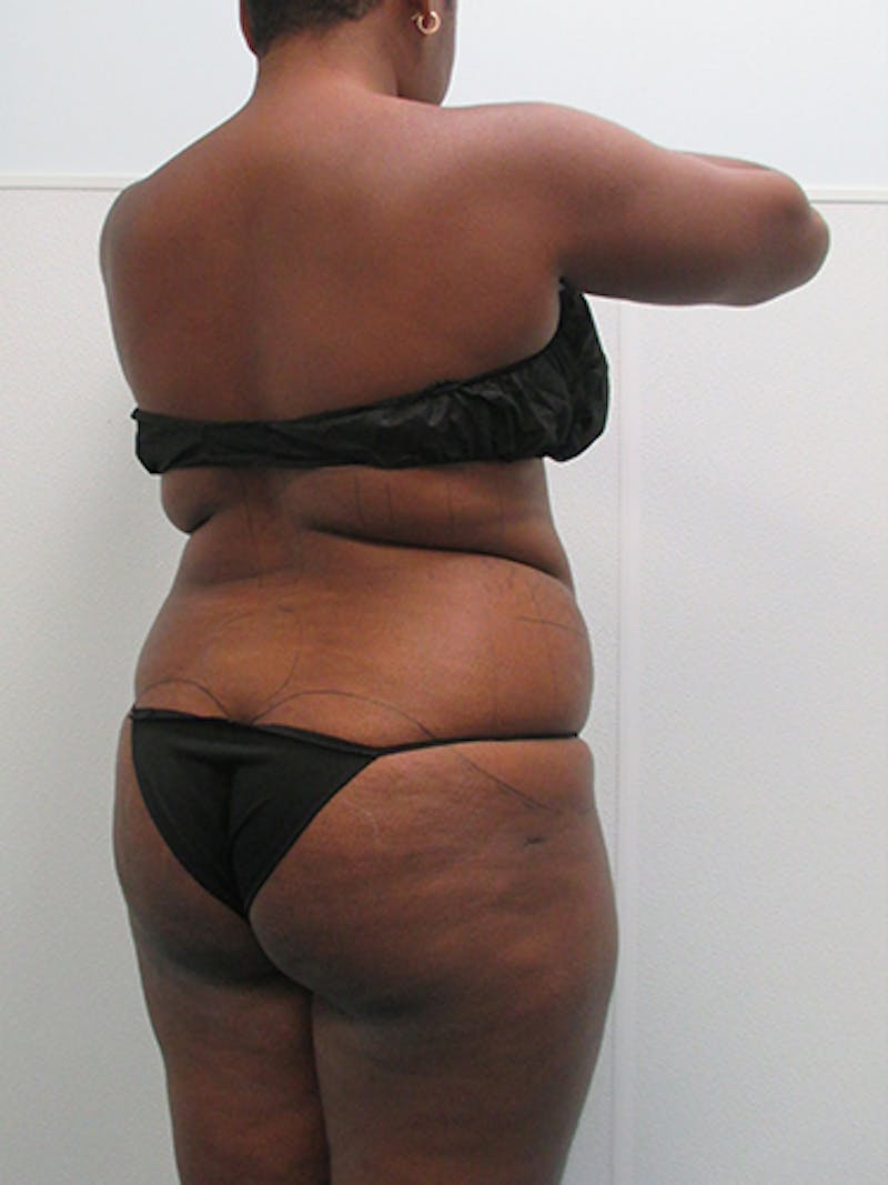Liposuction Before & After Gallery - Patient 140815 - Image 3