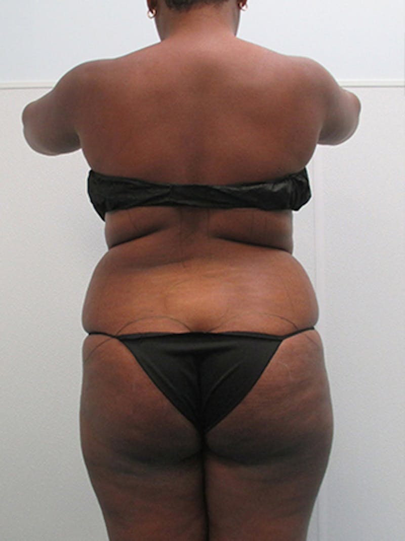 Liposuction Before & After Gallery - Patient 140815 - Image 5