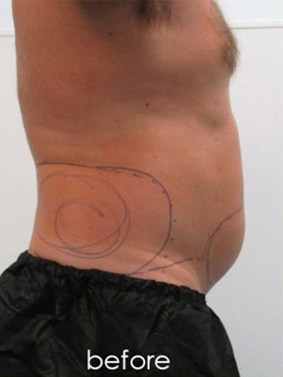 Liposuction Before & After Gallery - Patient 400467 - Image 1