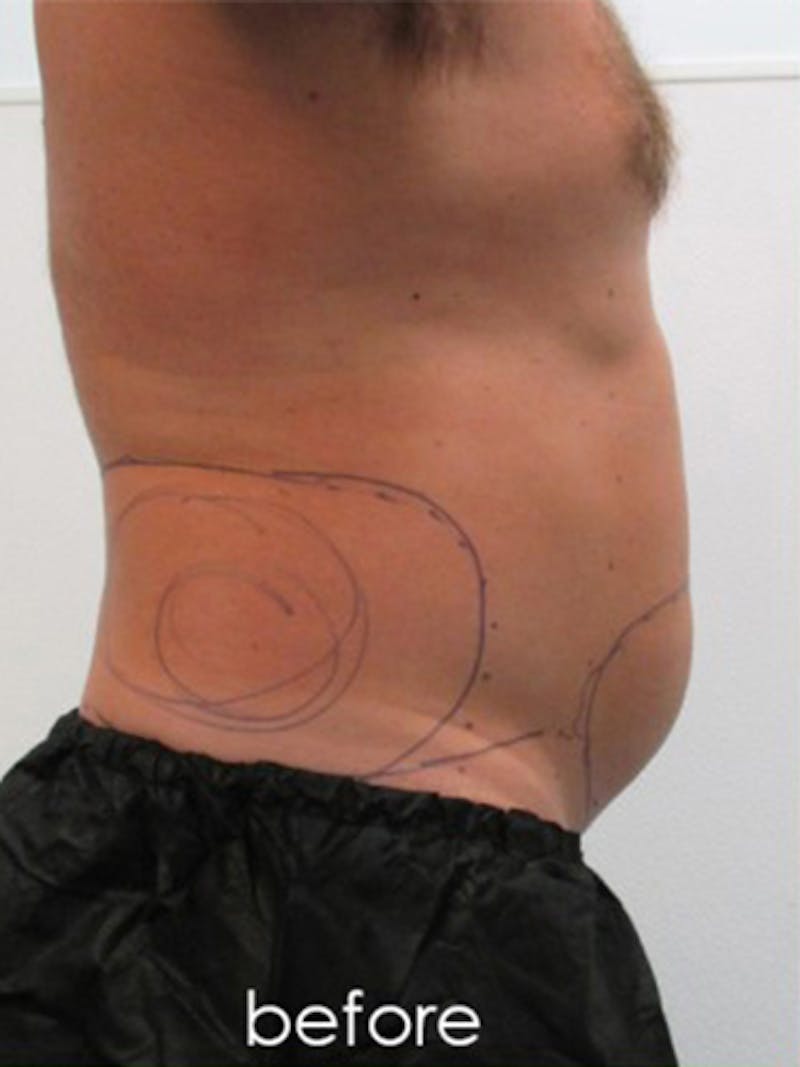 Silhouette Liposuction Before & After Gallery - Patient 504548 - Image 1