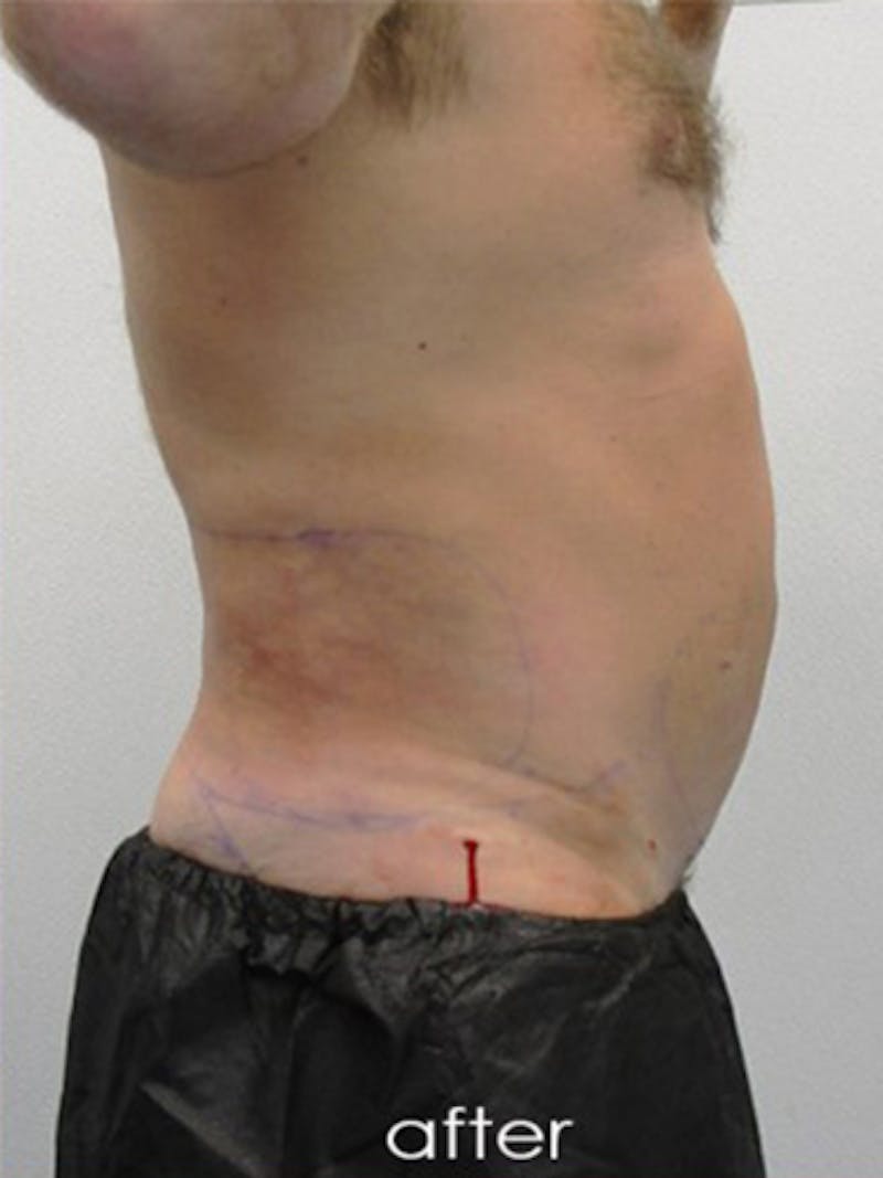 Silhouette Liposuction Before & After Gallery - Patient 504548 - Image 2