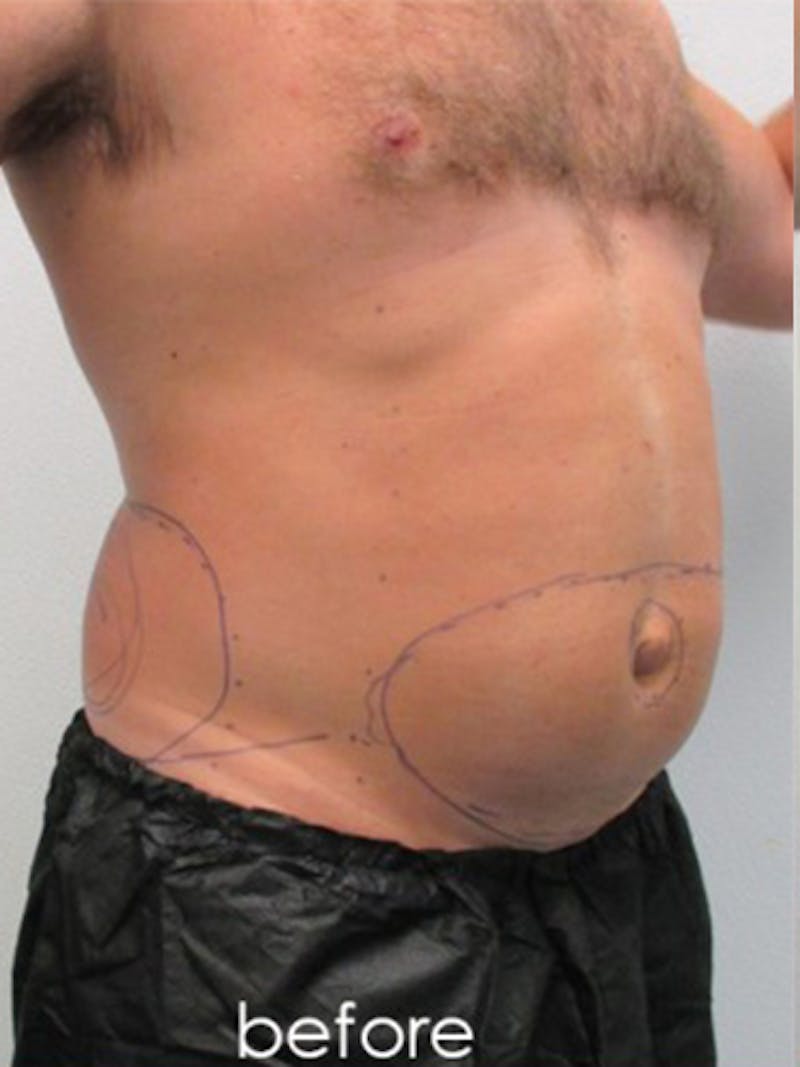 Silhouette Liposuction Before & After Gallery - Patient 504548 - Image 3