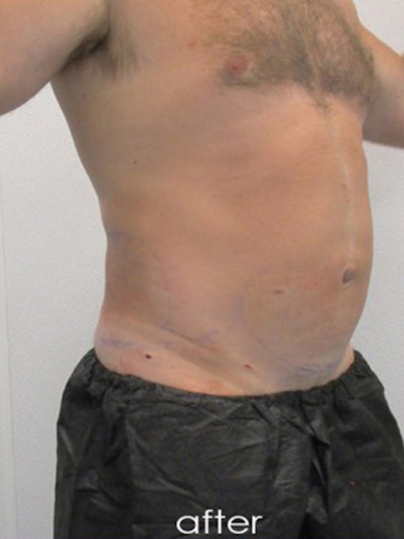 Silhouette Liposuction Before & After Gallery - Patient 504548 - Image 4