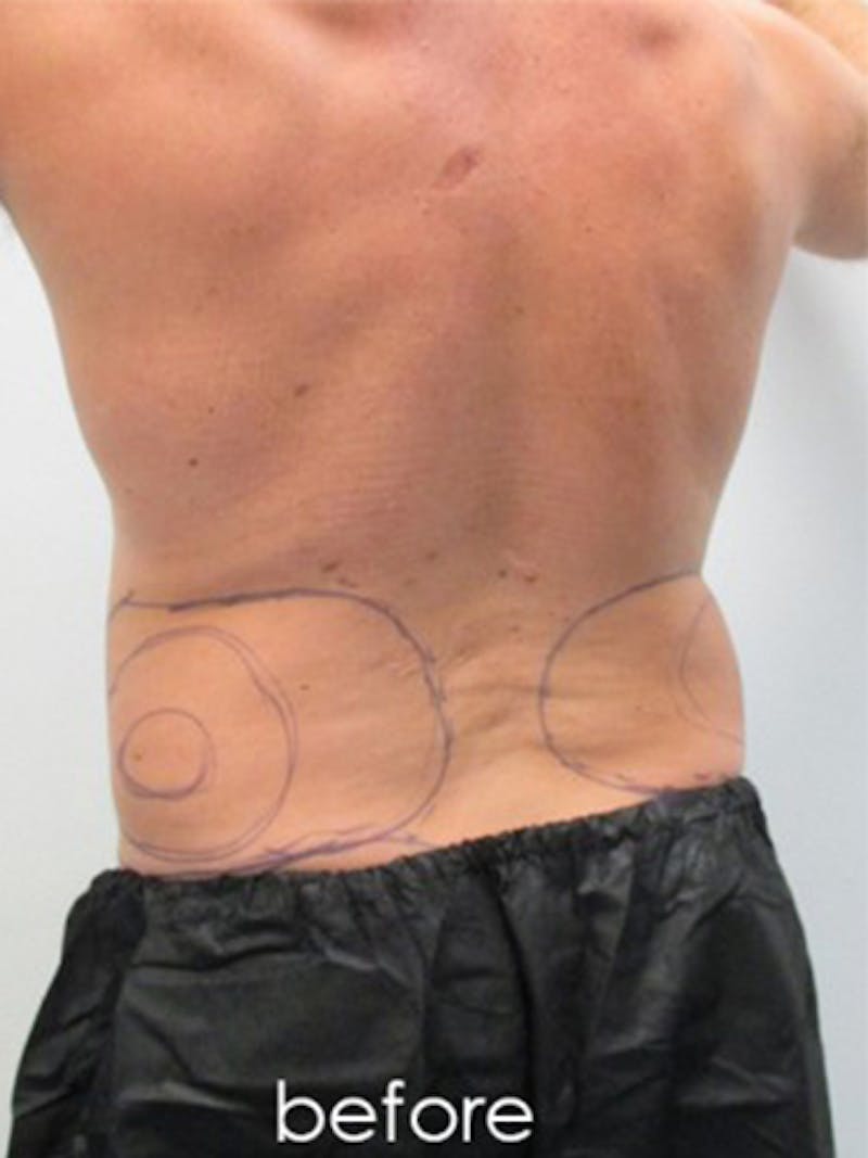 Silhouette Liposuction Before & After Gallery - Patient 504548 - Image 5