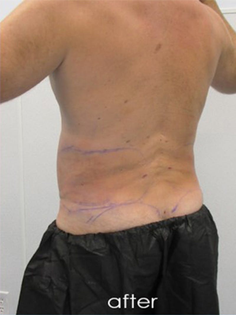 Silhouette Liposuction Before & After Gallery - Patient 504548 - Image 6