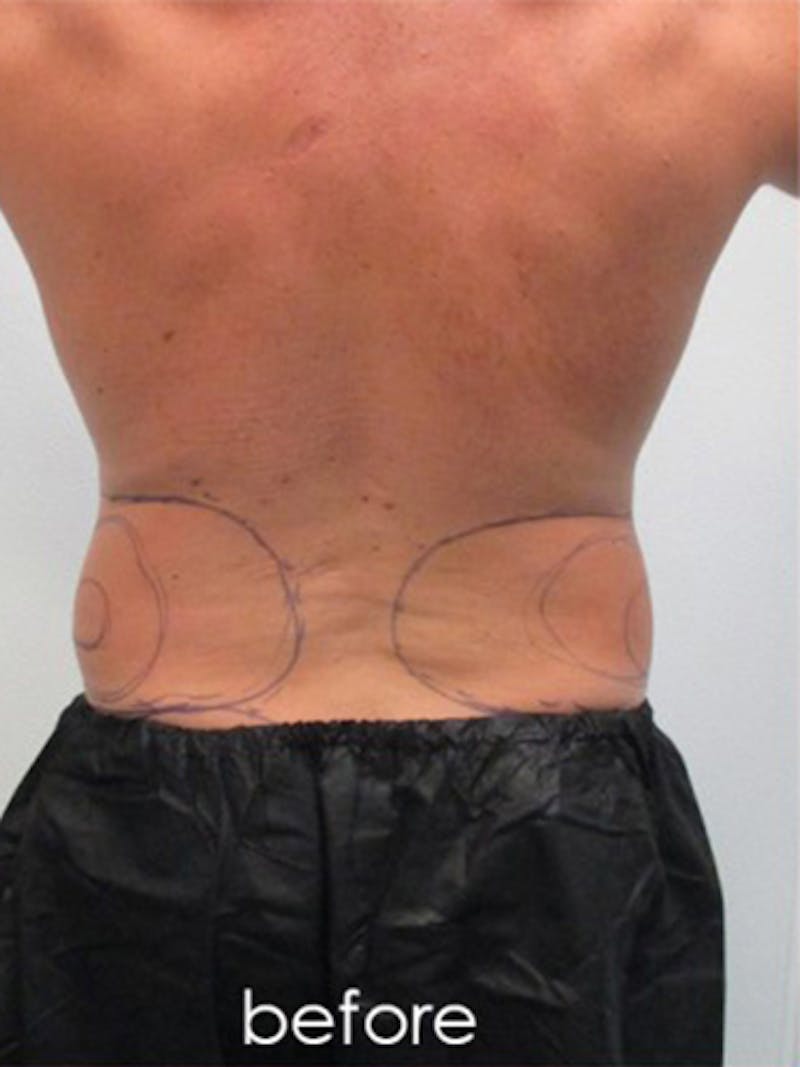 Silhouette Liposuction Before & After Gallery - Patient 504548 - Image 7