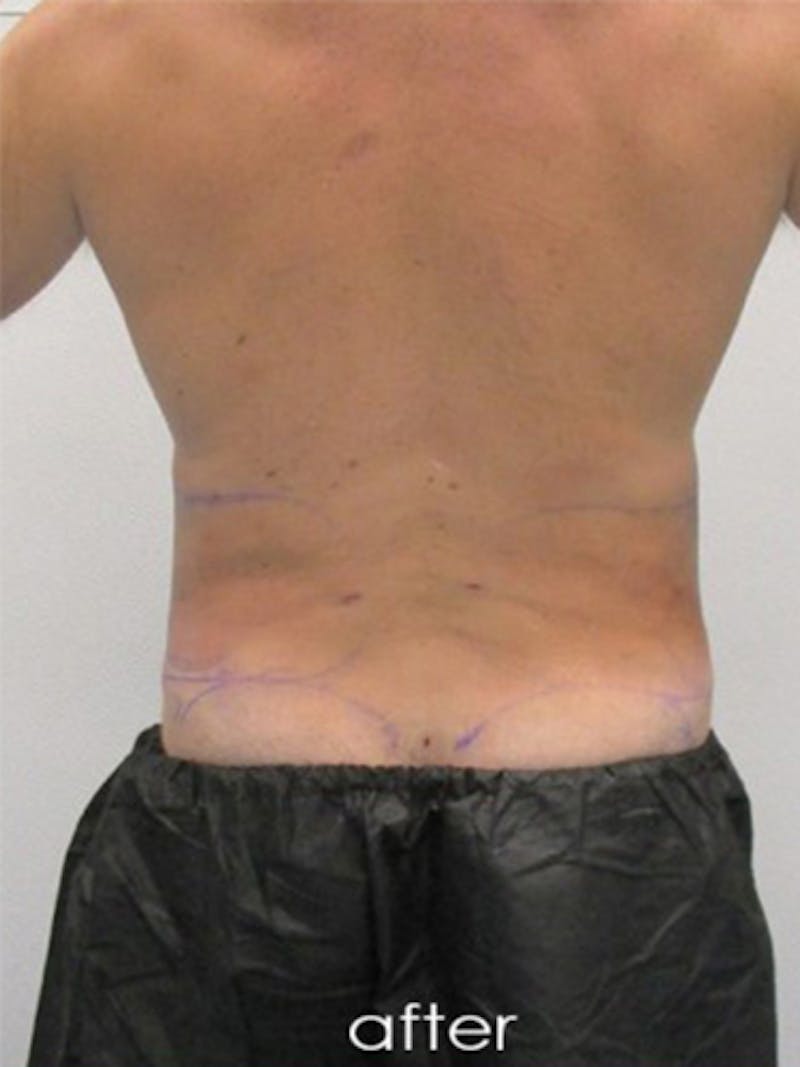 Silhouette Liposuction Before & After Gallery - Patient 504548 - Image 8