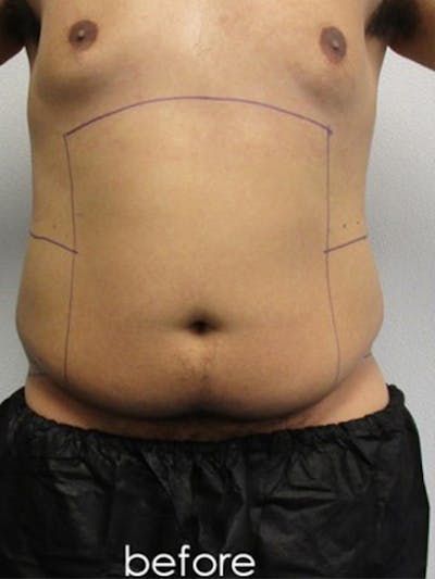 Liposuction Before & After Gallery - Patient 817476 - Image 1