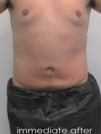 Liposuction Before & After Gallery - Patient 817476 - Image 2