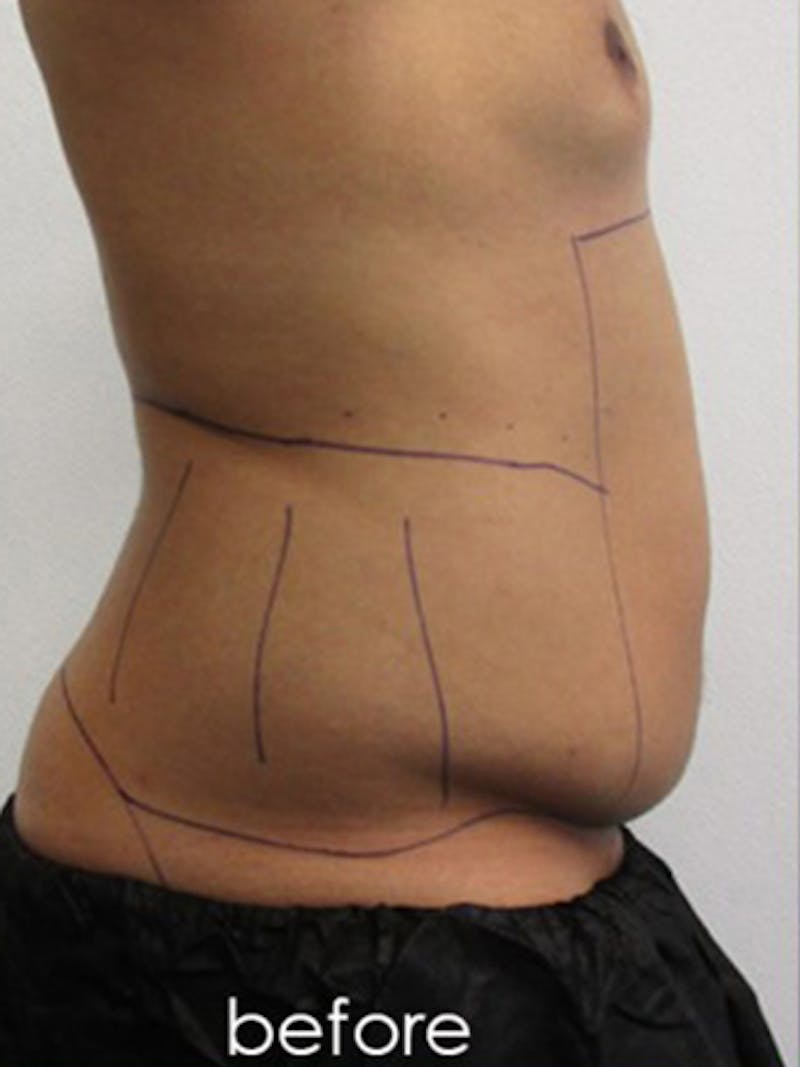Liposuction Before & After Gallery - Patient 817476 - Image 3