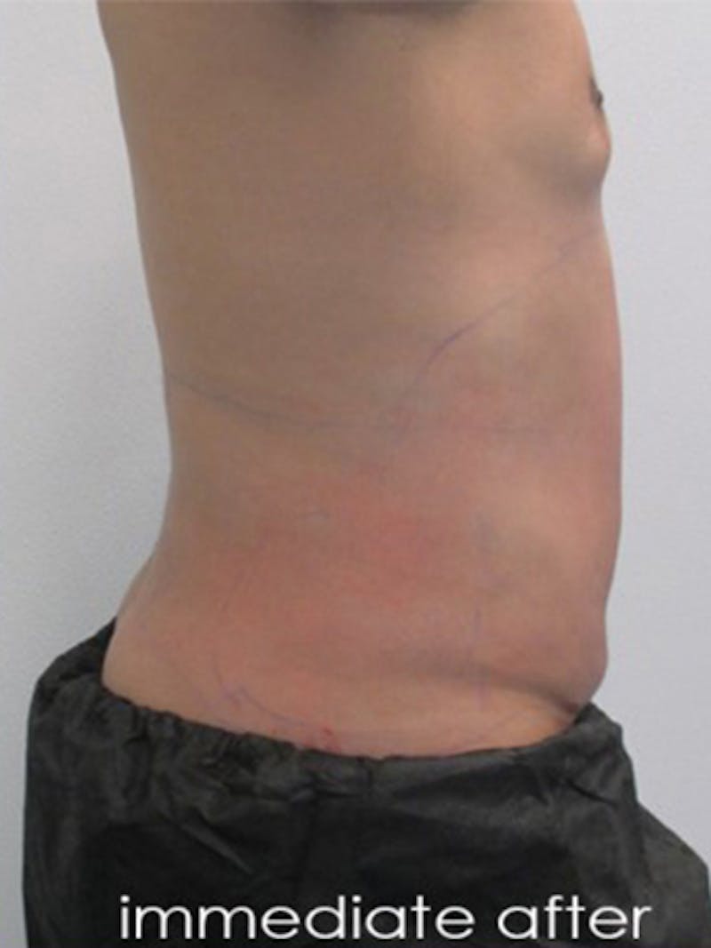 Liposuction Before & After Gallery - Patient 817476 - Image 4