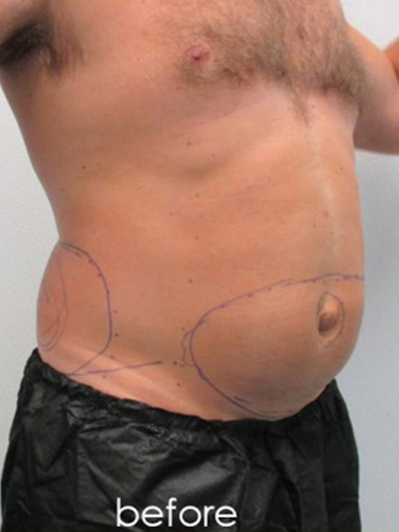 Liposuction Before & After Gallery - Patient 817476 - Image 5