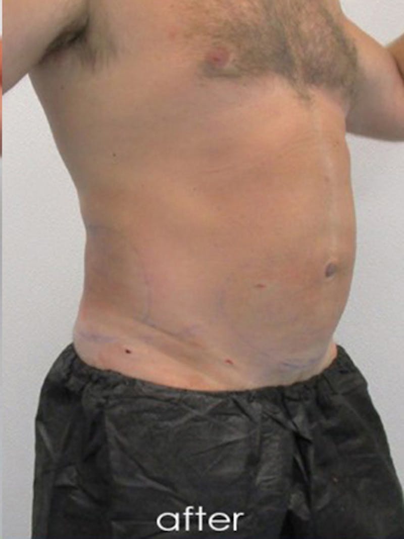 Liposuction Before & After Gallery - Patient 817476 - Image 6