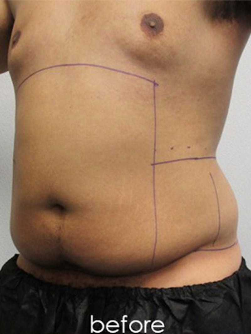 Liposuction Before & After Gallery - Patient 817476 - Image 7