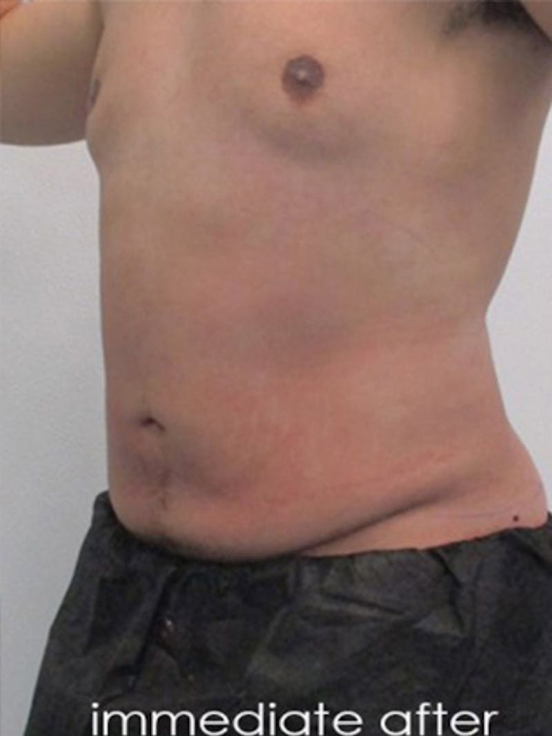 Liposuction Before & After Gallery - Patient 817476 - Image 8