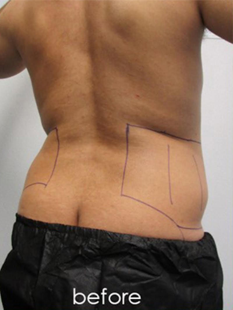 Liposuction Before & After Gallery - Patient 817476 - Image 9