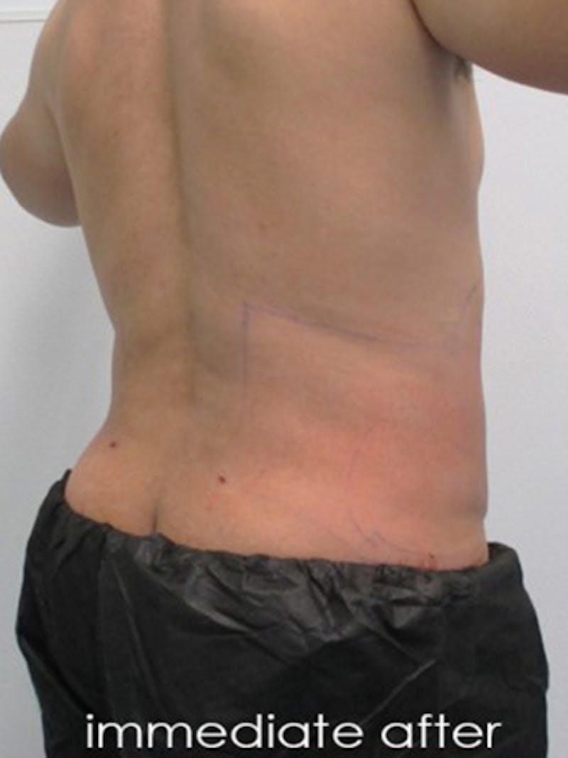 Liposuction Before & After Gallery - Patient 817476 - Image 10
