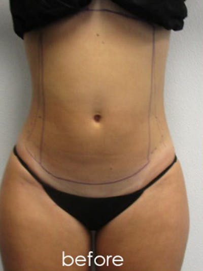 Liposuction Before & After Gallery - Patient 366034 - Image 1