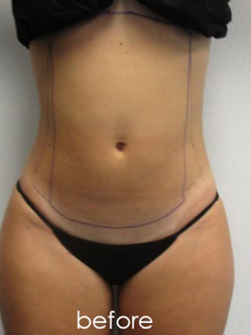 Liposuction Before & After Gallery - Patient 366034 - Image 1