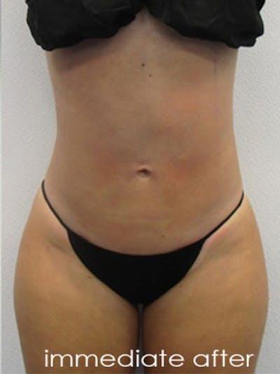 Liposuction Before & After Gallery - Patient 366034 - Image 2