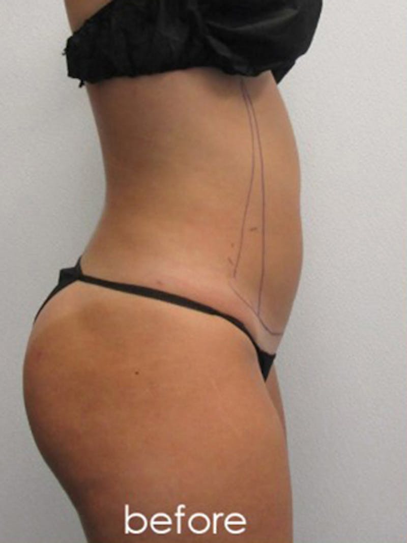 Liposuction Before & After Gallery - Patient 366034 - Image 3