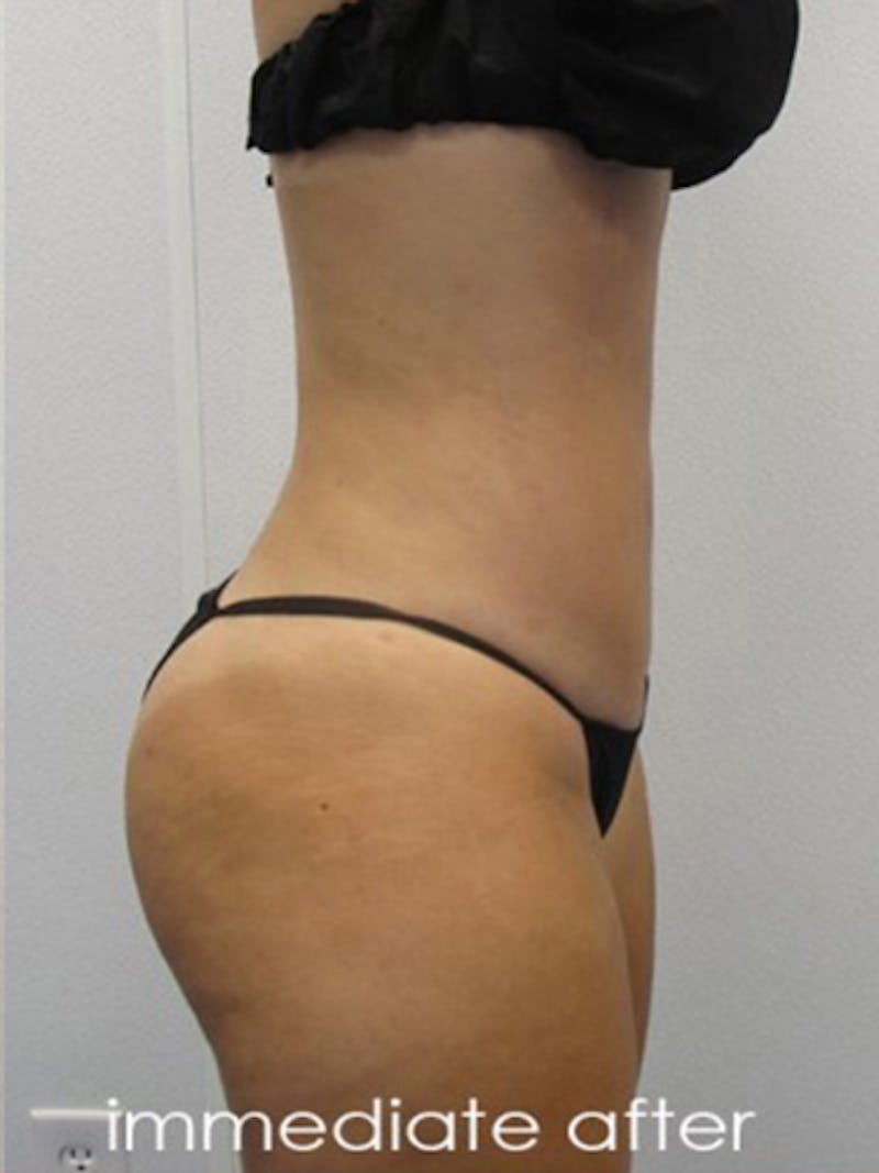 Liposuction Before & After Gallery - Patient 366034 - Image 4