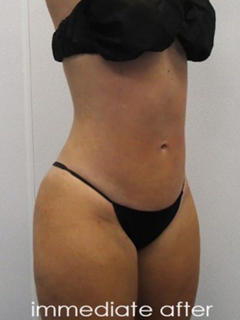 Liposuction Before & After Gallery - Patient 366034 - Image 6