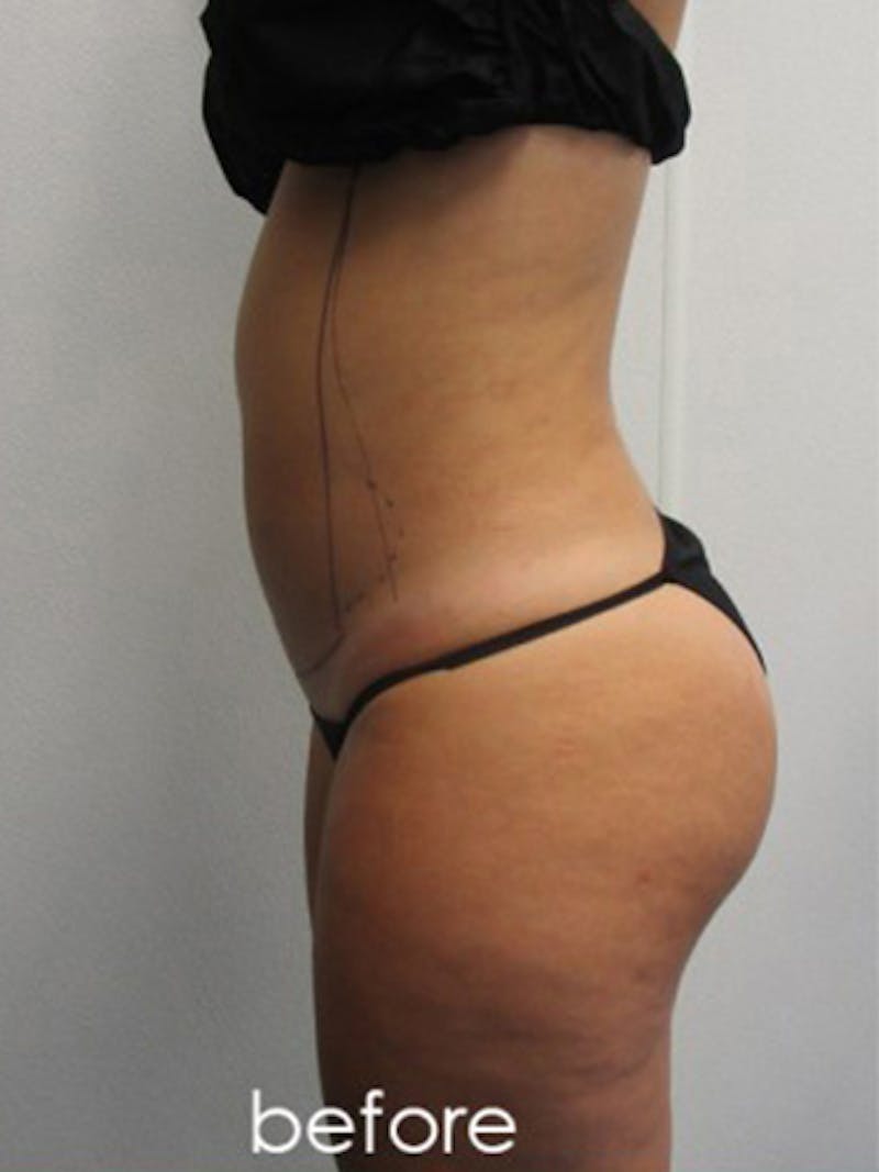Liposuction Before & After Gallery - Patient 366034 - Image 7