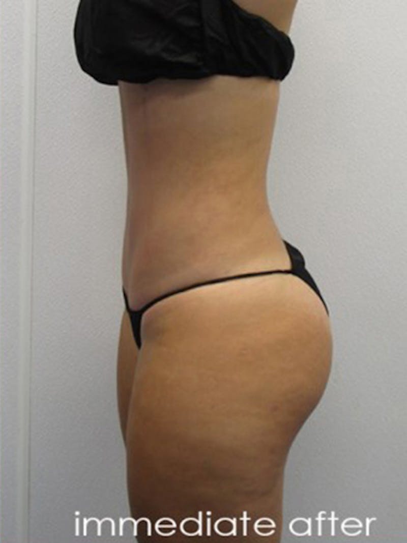 Liposuction Before & After Gallery - Patient 366034 - Image 8