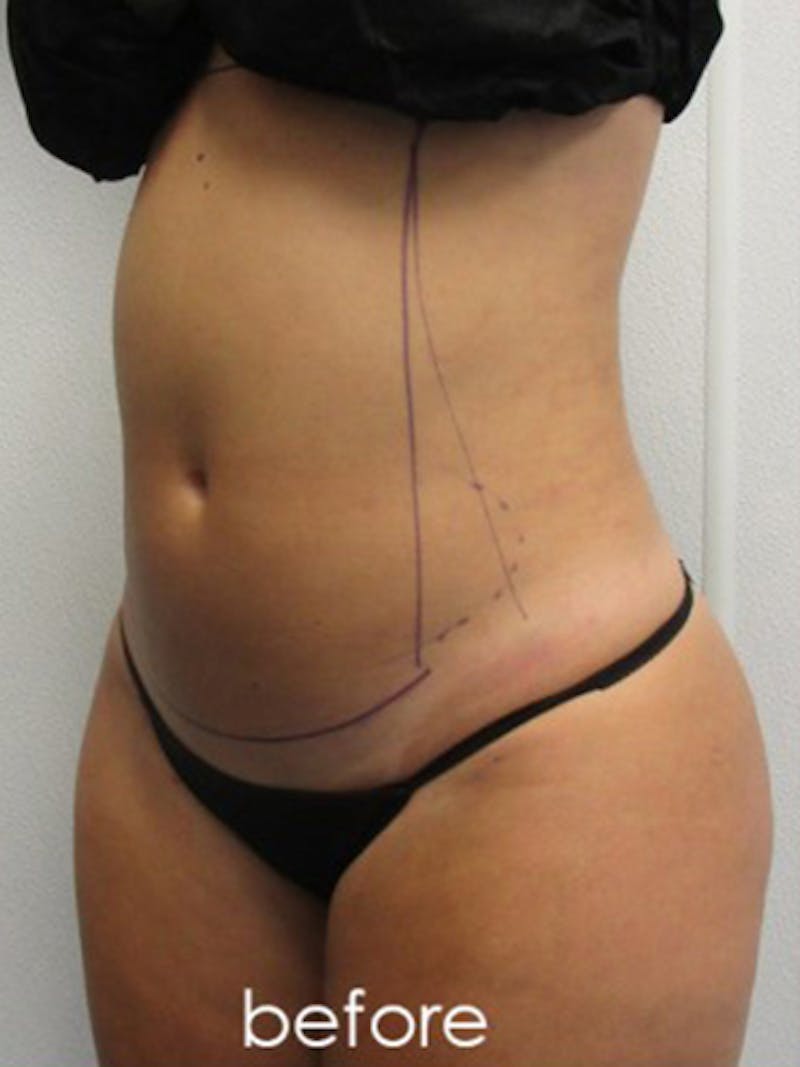 Liposuction Before & After Gallery - Patient 366034 - Image 9