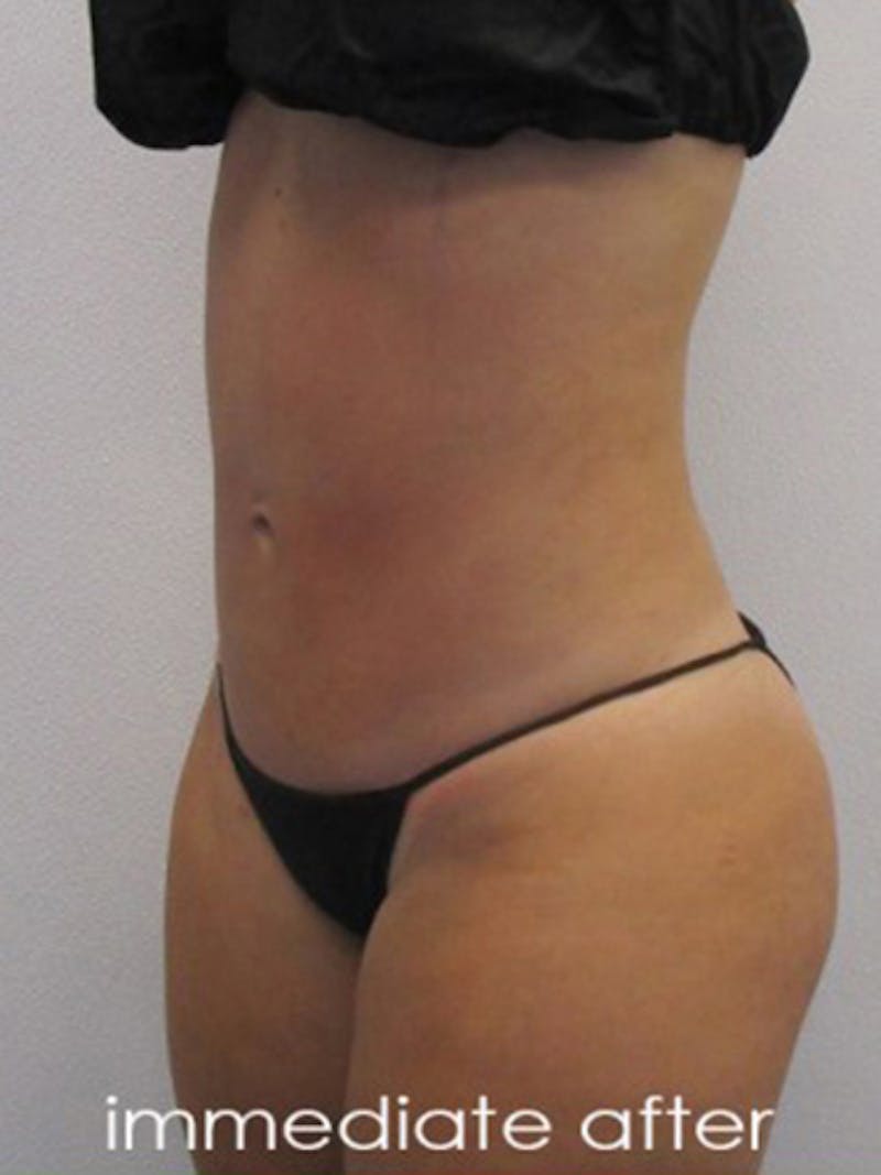 Liposuction Before & After Gallery - Patient 366034 - Image 10
