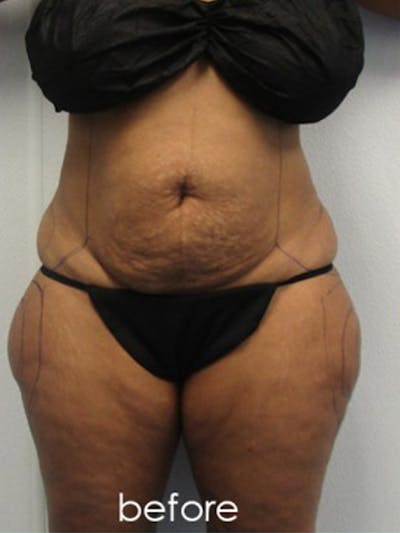 Liposuction Before & After Gallery - Patient 390928 - Image 1