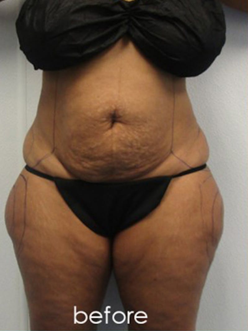 Silhouette Liposuction Before & After Gallery - Patient 416387 - Image 1
