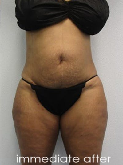 Liposuction Before & After Gallery - Patient 390928 - Image 2