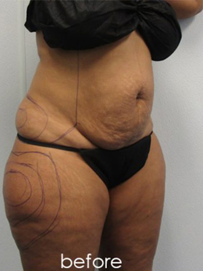 Silhouette Liposuction Before & After Gallery - Patient 416387 - Image 3