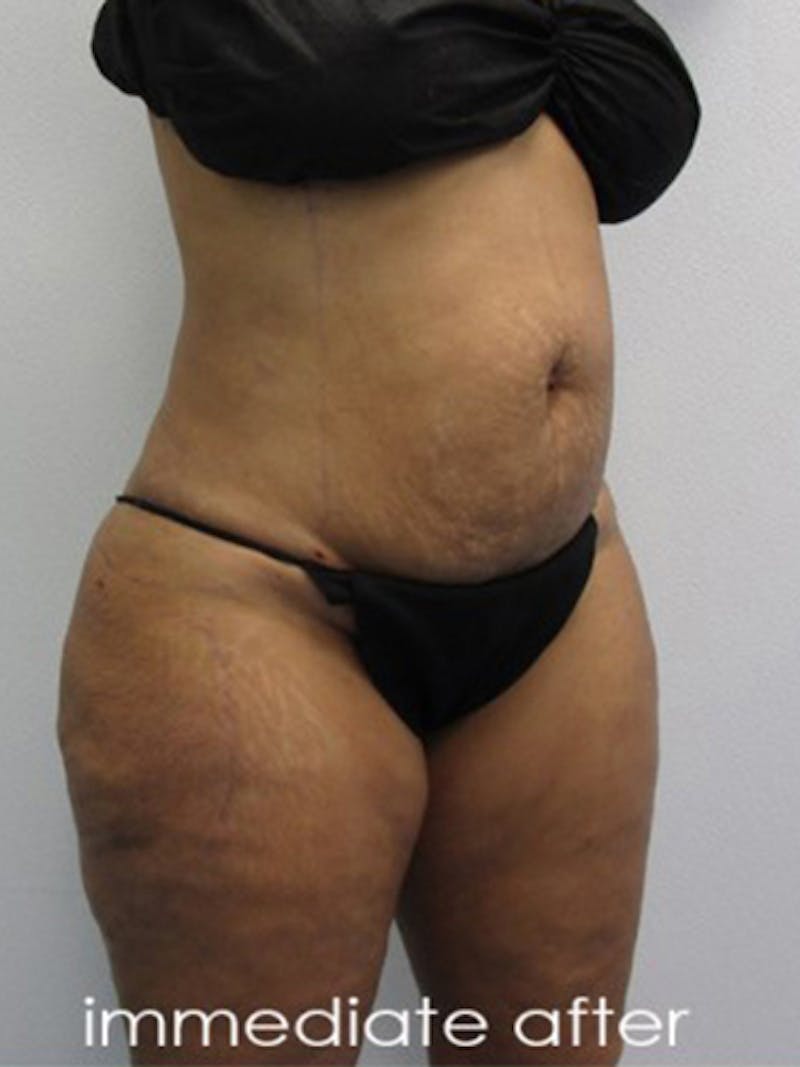 Silhouette Liposuction Before & After Gallery - Patient 416387 - Image 4