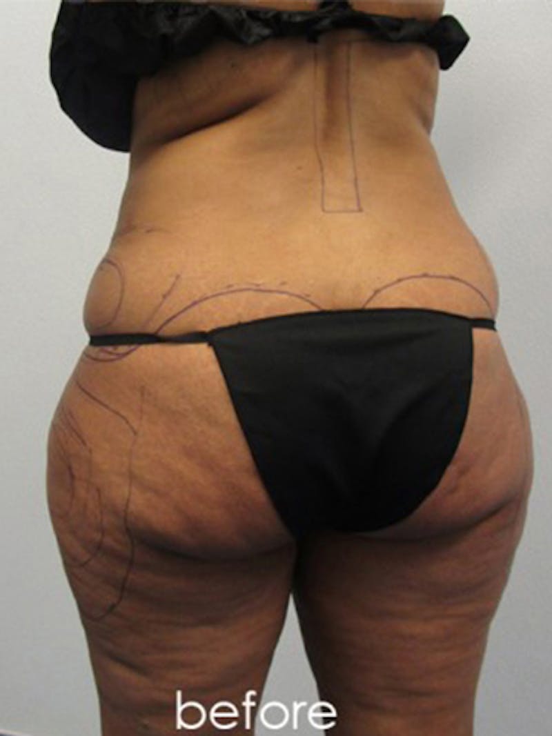 Silhouette Liposuction Before & After Gallery - Patient 416387 - Image 5