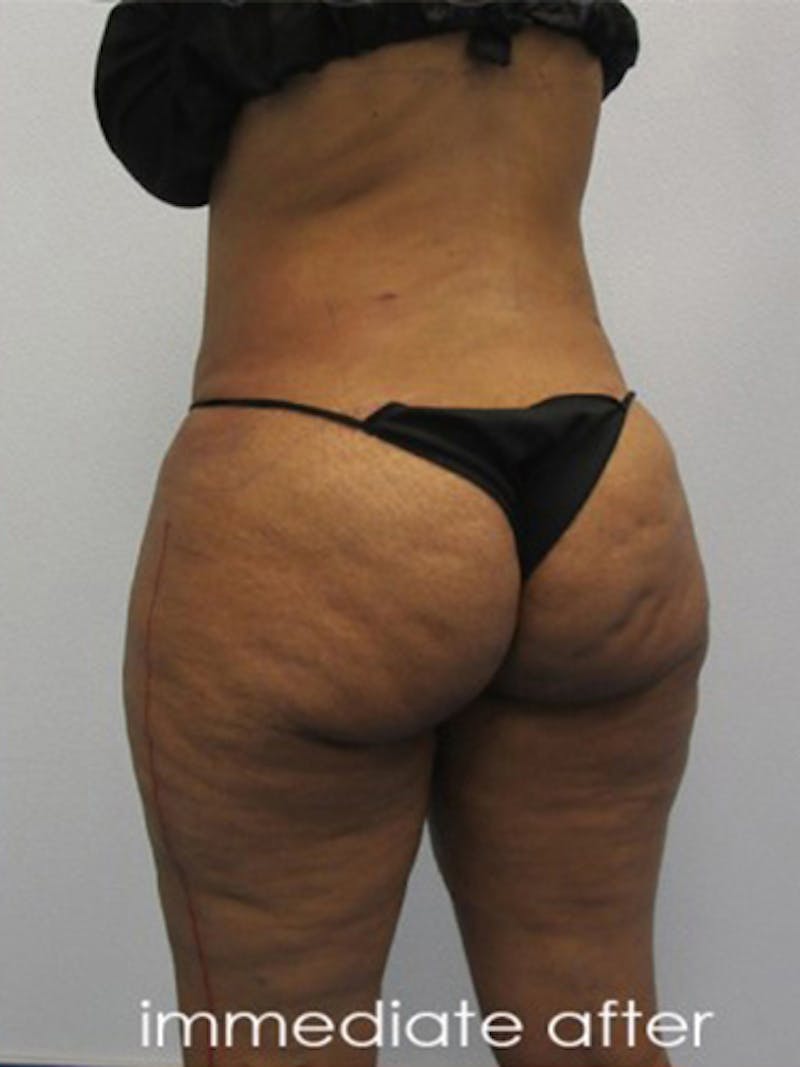 Silhouette Liposuction Before & After Gallery - Patient 416387 - Image 6