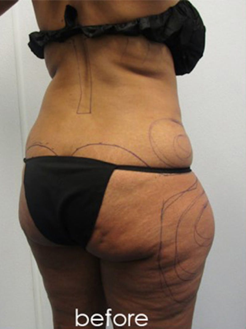 Silhouette Liposuction Before & After Gallery - Patient 416387 - Image 7