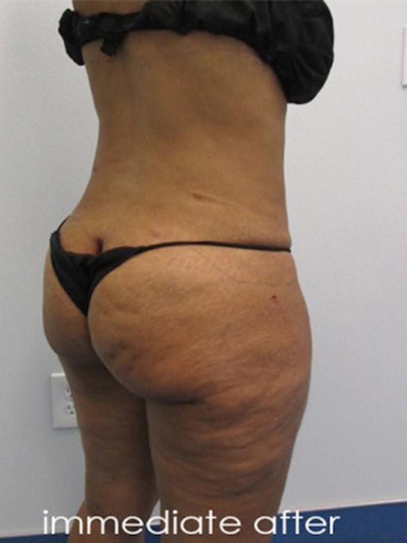 Silhouette Liposuction Before & After Gallery - Patient 416387 - Image 8