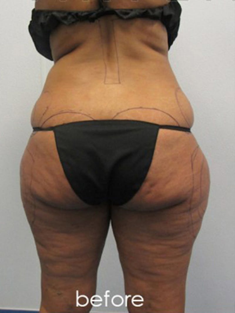 Silhouette Liposuction Before & After Gallery - Patient 416387 - Image 9