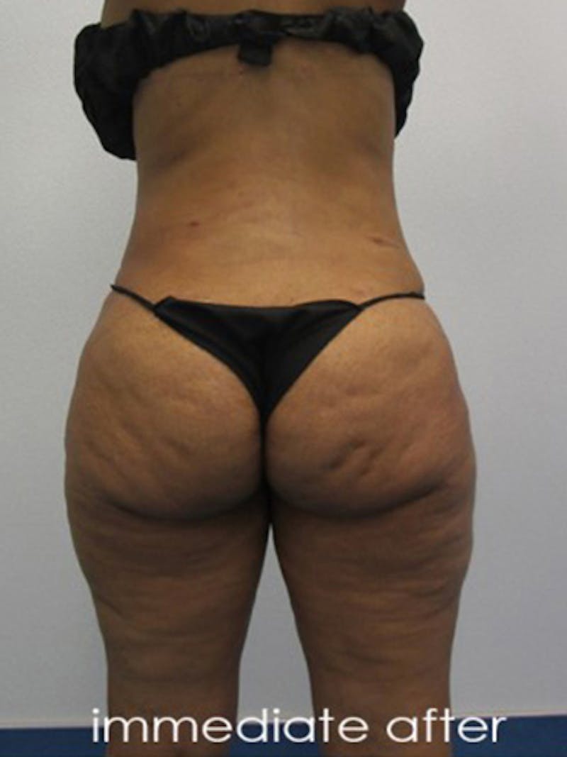 Silhouette Liposuction Before & After Gallery - Patient 416387 - Image 10