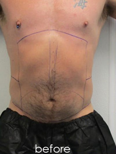 Liposuction Before & After Gallery - Patient 225001 - Image 1