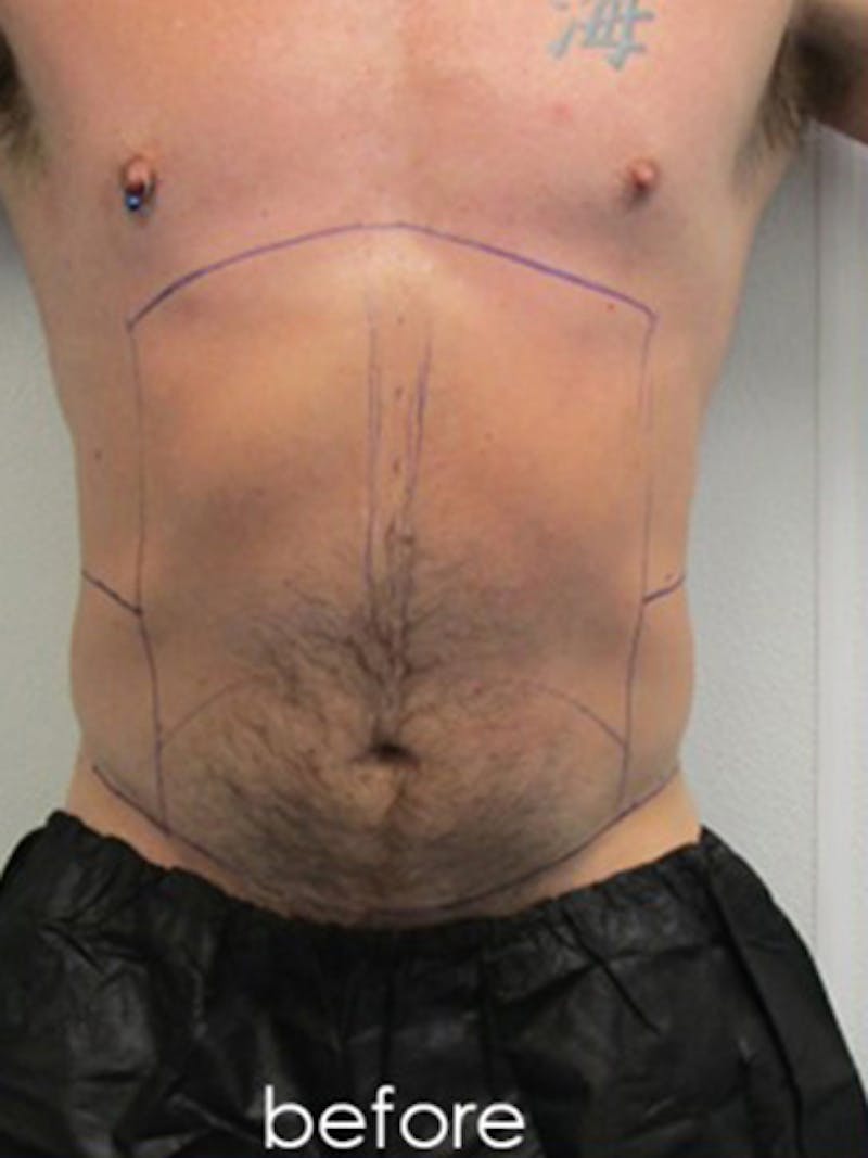 Liposuction Before & After Gallery - Patient 225001 - Image 1