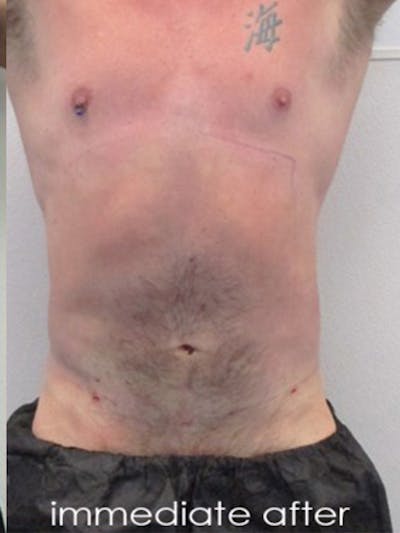 Liposuction Before & After Gallery - Patient 225001 - Image 2