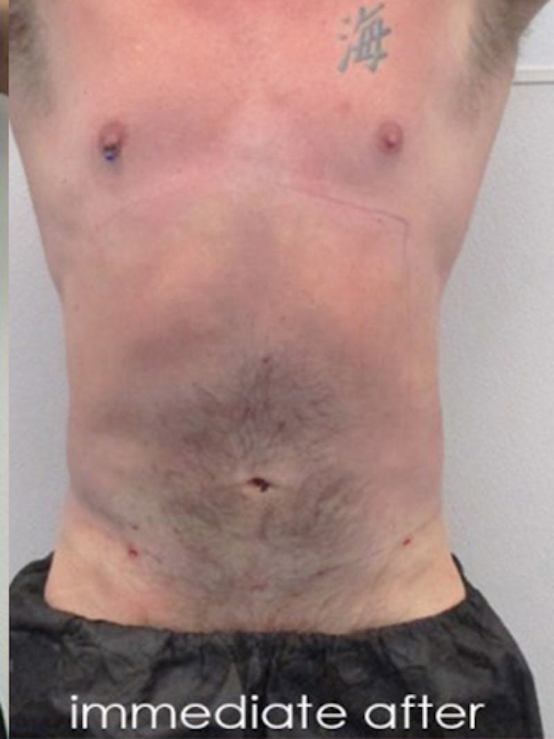Liposuction Before & After Gallery - Patient 225001 - Image 2